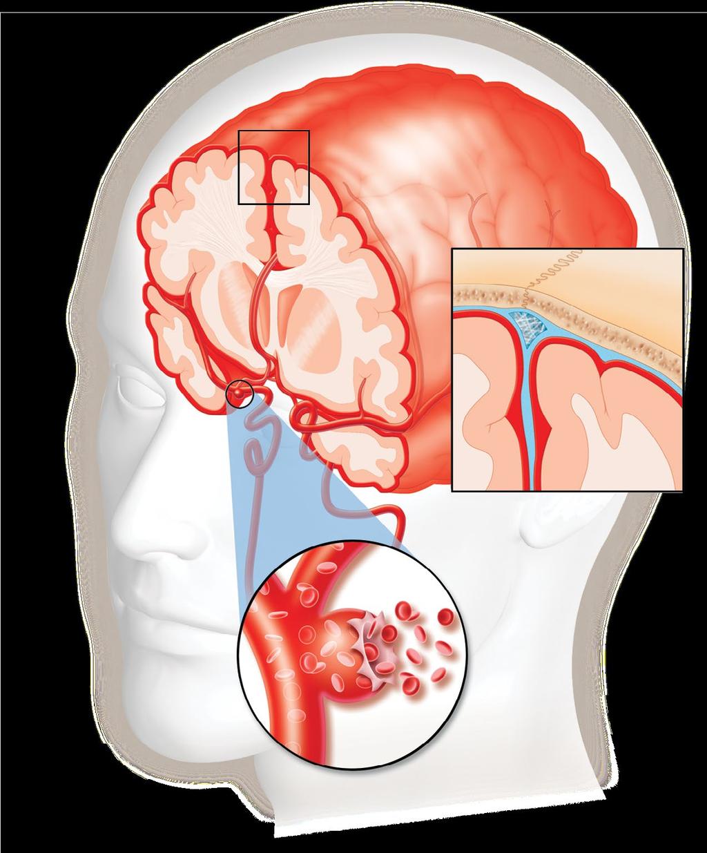Subarachnoid Hemorrhage Subarachnoid Space Middle Cerebral Artery Saccular Aneurysm Subarachnoid Space (in Blue) Between Skull and Brain (enlarged view) Another kind of hemorrhagic stroke is called a