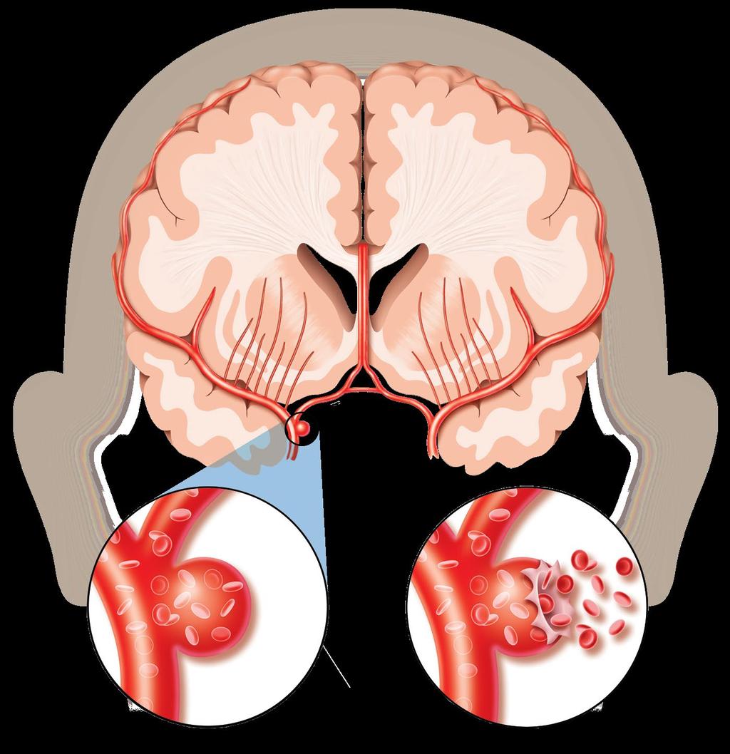 Aneurysm Middle Cerebral Artery Aneurysm Saccular Aneurysm Ruptured