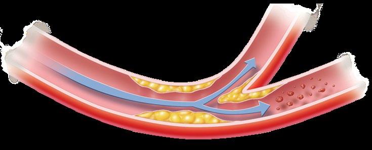 Blood Flow in Normal and Blocked Arteries NORMAL Blood flows easily through a