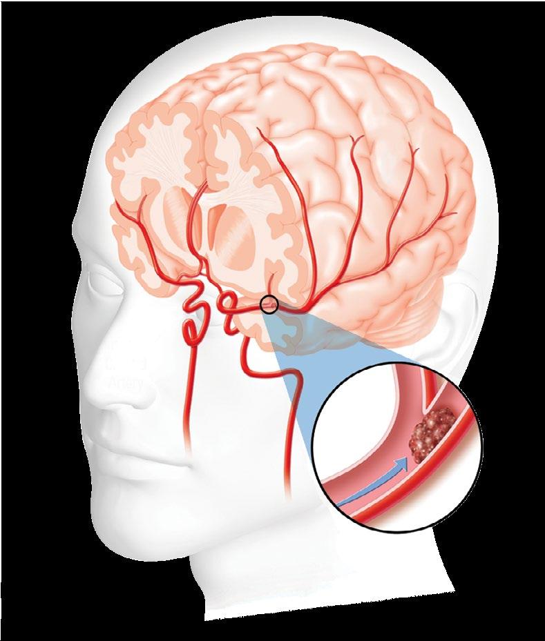 Transient Ischemic Attack (TIA) Interior Cerebral Artery Middle Cerebral Artery Internal Carotid Artery Blockage If an artery within the brain or one that goes to the brain is blocked for a short
