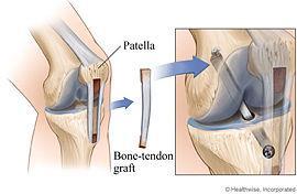 Patellar Tendon Graft Bone-tendon-bone graft is harvested from the middle third of the patellar tendon Graft is