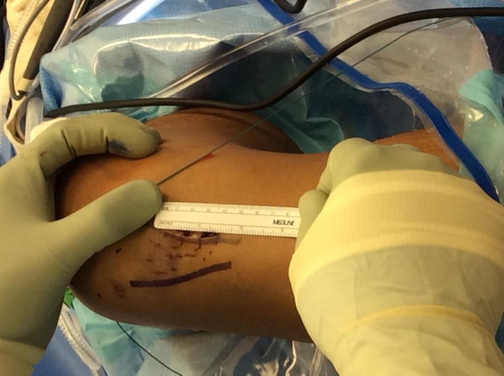 Minimally Invasive ACL Surgery Incision is based over medial aspect of patellar tendon Allows for exposure