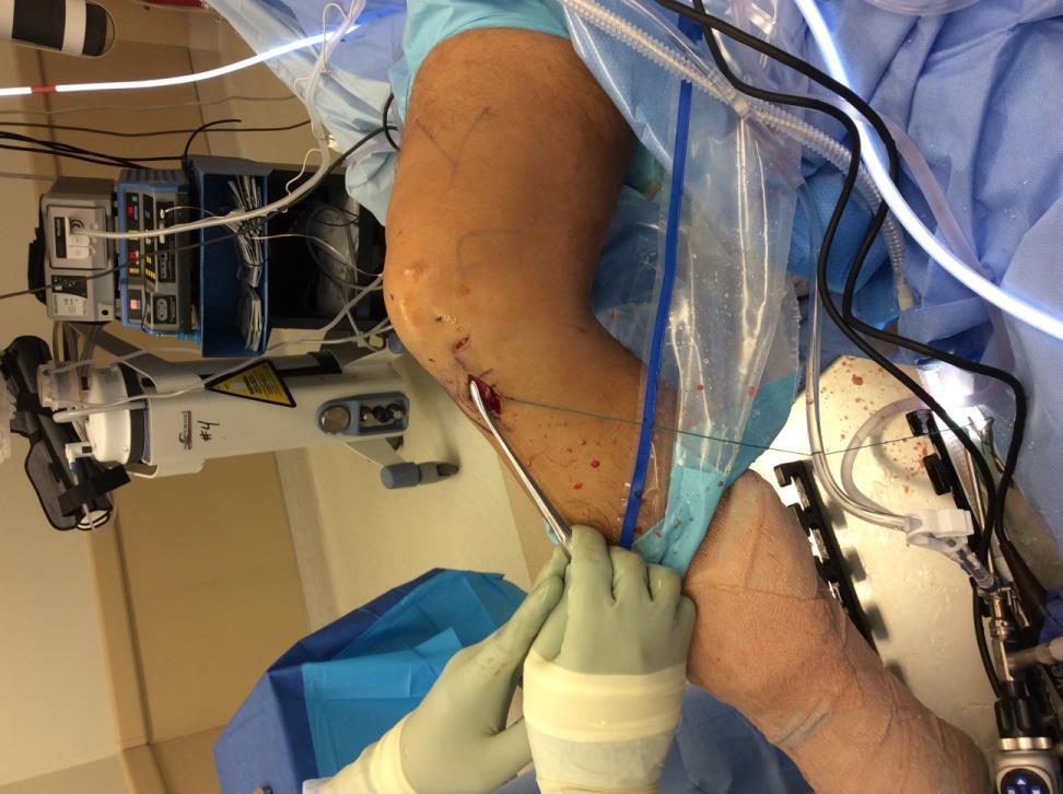 Minimally Invasive ACL Surgery