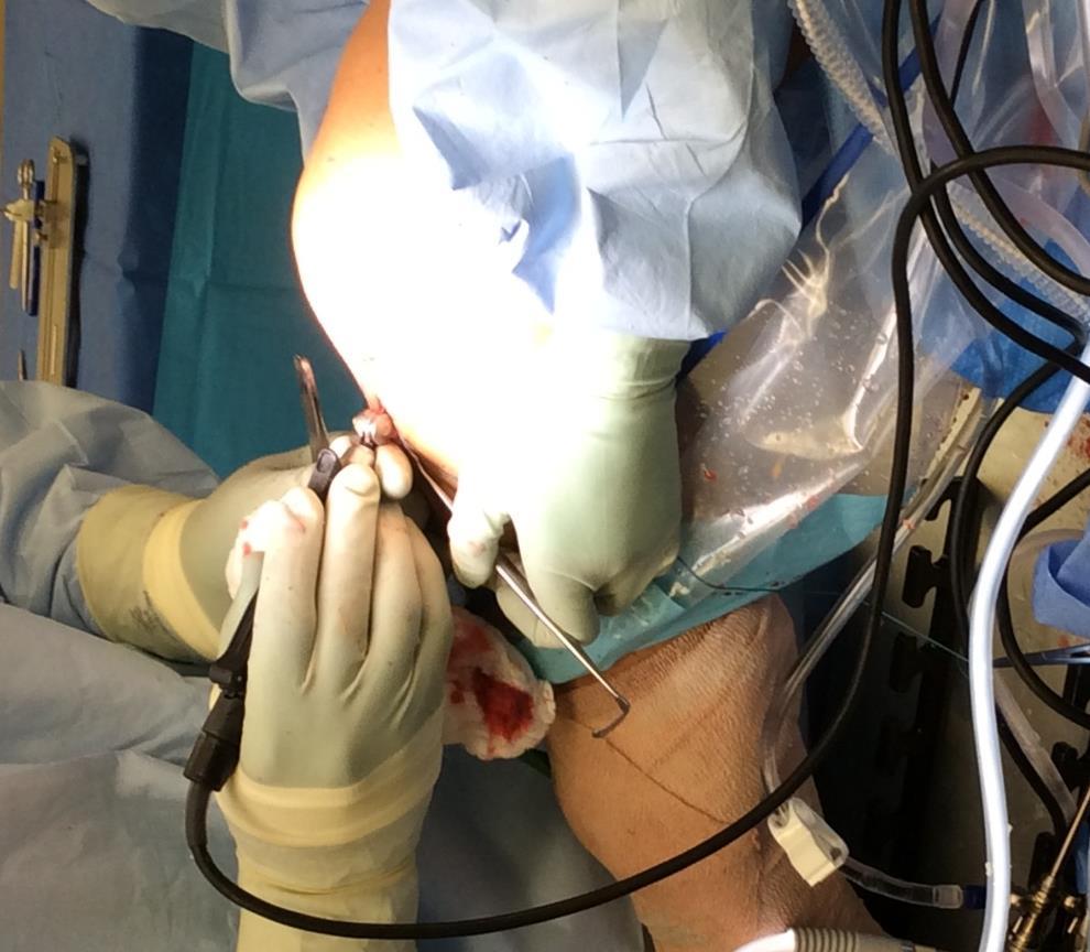 Minimally Invasive ACL Surgery Distal end of