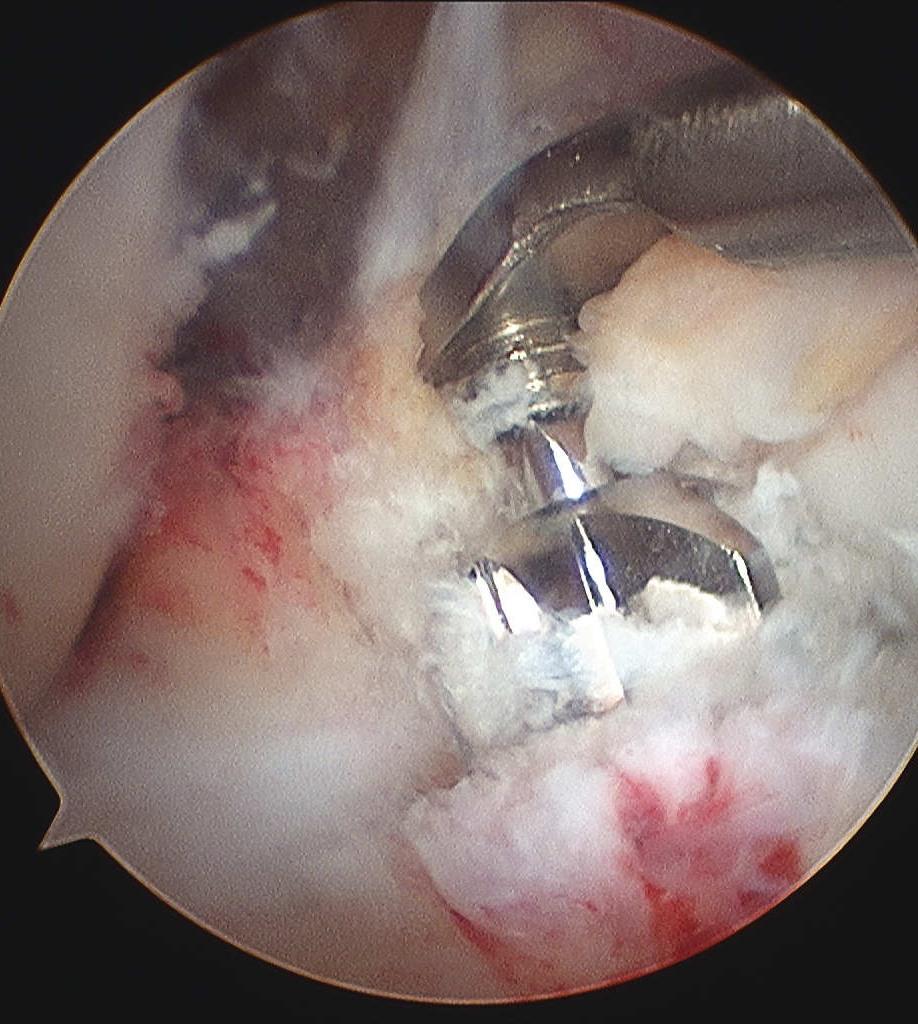 Tibial side A drill bit and guide are placed through the medial portal and positioned on the tibia 6-8mm anterior to