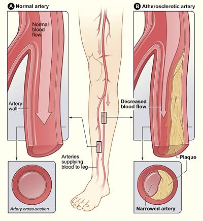 Peripheral Artery Disease http://www.nhlbi.