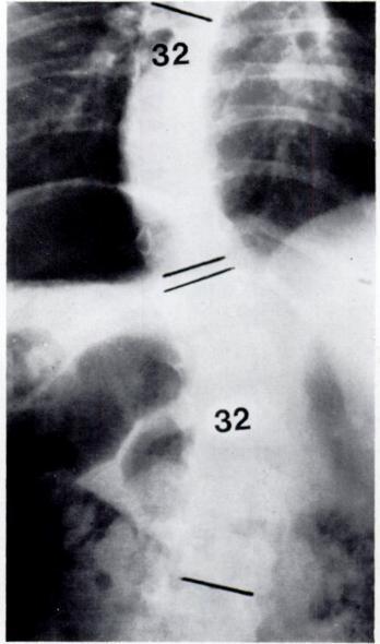 RIB-VERTEBRA ANGLE IN INFANTILE SCOLIOSIS 239 thoracic level is therefore always a negative figure.