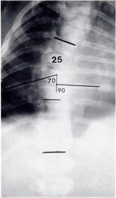 RIB-VERTEBRA ANGLE IN INFANTILE SCOLIOSIS 233 of the degree of obliquity of the convex side ribs associated with a thoracic or thoraco-lumbar scoliosis.