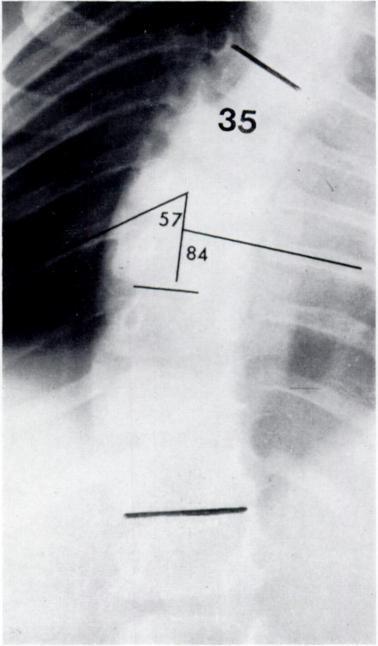 5 FIG. 6 To illustrate the early stages of progressive infantile scoliosis. Figure 5-Radiograph of a mild curve in a boy of 5 months. The convex side apical rib head, the ninth, is in Phase I.