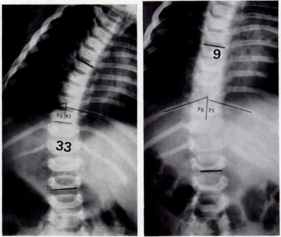 238 NI. II. \IEHTA FIG. 9 FIG. 10 FIG. 11 A case of resolving infantile scoliosis.