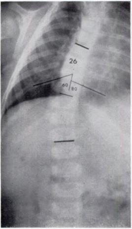 difference of 10 degrees strongly suggests a diagnosis of resolving scoliosis.