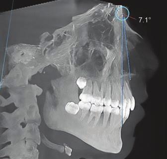Evaluation of Mandibular Dental and Basal Arch Dimensions imported into on-demand 3D software (CyberMed, Finland) for 3D volumetric rendering.