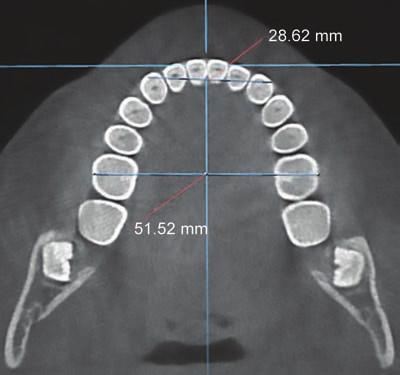 26 The skeletal class was evaluated depending on the ANB angle as shown in Figure 1. To obtain repeatable standard sections, reorientation of each CBCT image was performed.