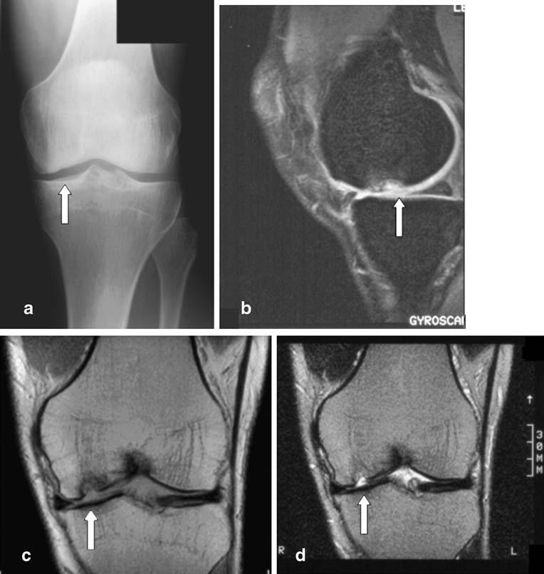 1134 Skeletal Radiol (2007) 36:1129 1139 Table 4 Osseous abnormalities detected on radiographs only, on radiographs and MRI, and on MRI only in 798 patients with non-acute knee complaints Osseous