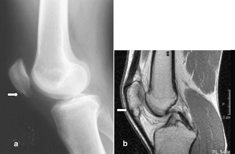 1136 Skeletal Radiol (2007) 36:1129 1139 Fig. 5 Eight-month-old healed fracture on both radiograph and MRI.