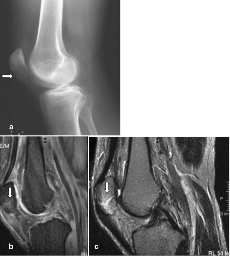 b Sagittal proton density SE image of the same patient, also delineating the healed fracture of the inferior pole of the patella Fig. 6 Two-month-old healing fracture on both radiograph and MRI.