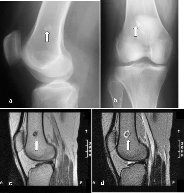 Skeletal Radiol (2007) 36:1129 1139 1137 reader (JLB) was blinded to all information and had no access to the radiographs. All 18 osseous abnormalities (1 caae of osteoarthritis Kellgren grade 3 [Fig.