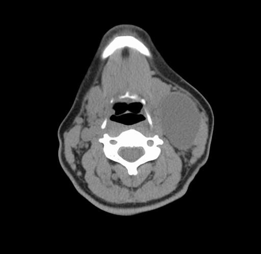 Branchial Cleft Cyst (thin walled) Congenital Neck Mass Location Lateral upper neck most common May also occur around the ear or low in the neck around the thyroid Findings Firm but not hard May be