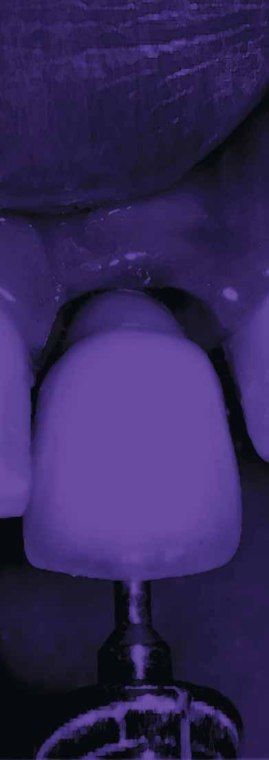 Ridge Split Procedure in the Atrophic Maxilla Udatta Kher B.D.S., M.D.S. Loss of teeth causes extensive resorption of the alveolar ridge.