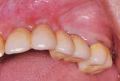 Primary stability for the implants is achieved by engaging the apical portion of the