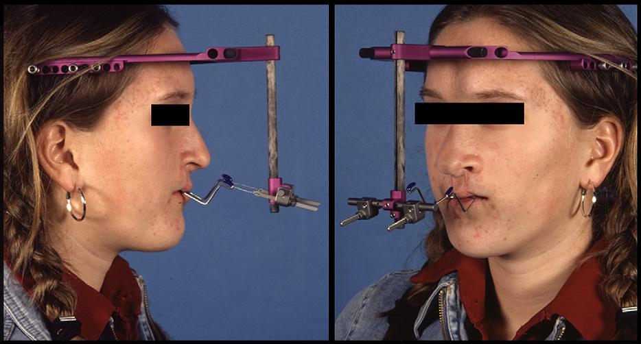 898 Nout et al. Fig. 1. Fixation of the halo-frame of the RED II system parallel to the Frankfurter horizontal plane. This cleft patient underwent a Le Fort I osteotomy.