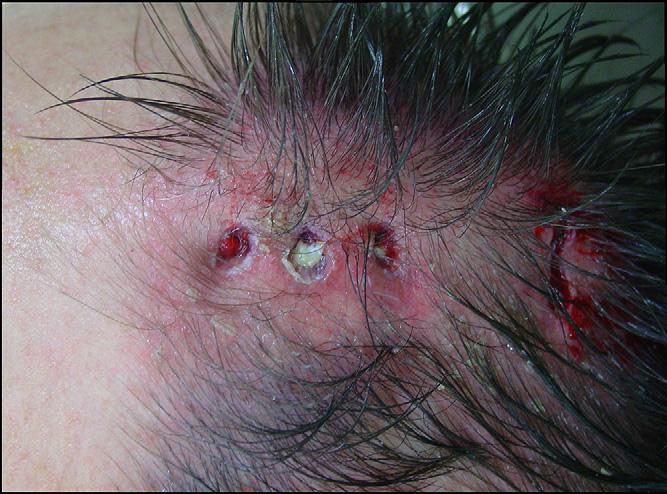 900 Nout et al. Fig. 2. Perioperative view of extensive scarring after traumatic frame migration due to a fall, which required surgical removal of the halo-frame. Fig. 3.