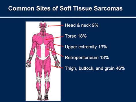 Sft tissue sarcmas are nt cmmn. But sft tissue sarcmas are very serius, especially if diagnsed when the disease is mre advanced.