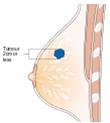 Stage T1 breast cancer Stage T2 breast cancer Stage T3 breast cancer The lymph (lymphatic) system of the breast The lymph system is important to understand because it is one way breast cancers can