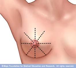VHA Policy on Breast Evaluation Techniques Recommendation VHA USPSTF Grade Teach breast self exam Against D: Harms outweigh benefits Clinical exam for screening beyond mammography for women 40+