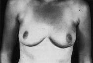 BREAST 451 Intact breast and postmastectomy 1. Skin telangiectasia. 2. Lymphoedema of the ipsilateral arm. 3. Rib fractures.