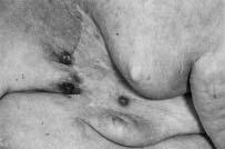 438 RADIOTHERAPY AND ONCOLOGY Fig. 26.4 Nodular local recurrence on the skin flaps of a mastectomy scar.