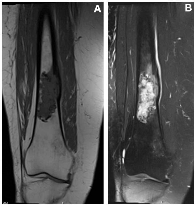 approximately 8 cm 3 cm, along with medial cortical wall erosion. Figure 2. Coronal T1 and T2 MRI views of the right femur.