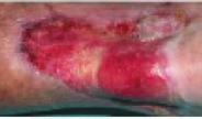Adv Wound Care (New Rochelle) 1(3): 127 32 Bellingeri A, Falciani F, Traspedini P (2016) Effect of a wound cleansing solution on wound bed preparation and inflammation in chronic wounds: a