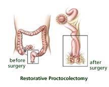 Current treatments and therapies for it are chemotherapy where they target the polyps on the colon and