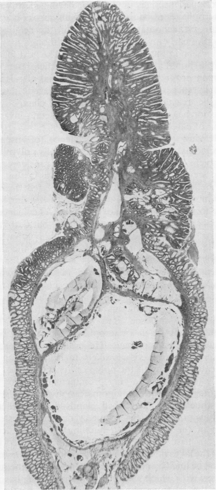 Pseudo-carcinomatous invasion in adenomatous polyps of the colon and rectum Fig. 4 Adenomatous polyp with pseudo-carcinomatous invasion of the stalk.