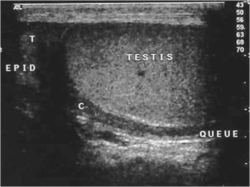 Fig. 4: Longitudinal USG of scrotum;, the epididymis appears