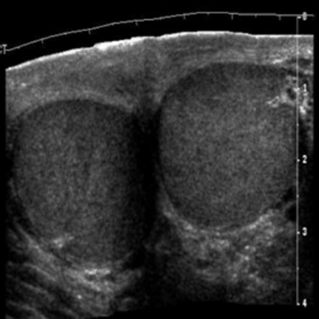Fig. 5: Trqansverse ultrasound section of both testis: The size and echogenicity of each testis