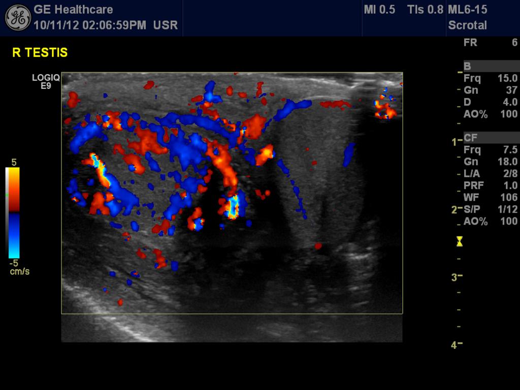 Fig. 9: Longitudinal US of left inguino scrotal region: congenital inguino scrotal hernia with communicating hydrocele. Fig.