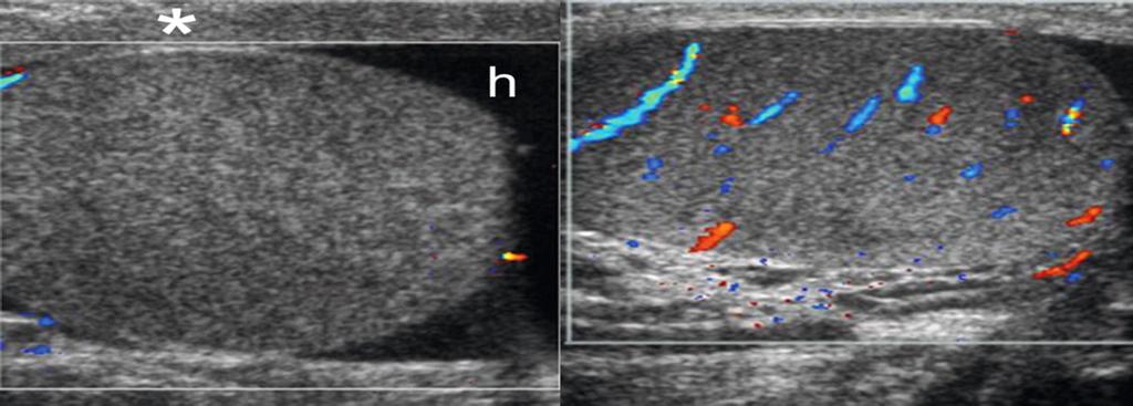 Fig. 16: Comparative color doppler study of both testis showing no