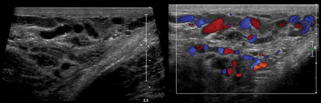 Fig. 20: (a and b) Grayscale and color Doppler ultrasound images of the