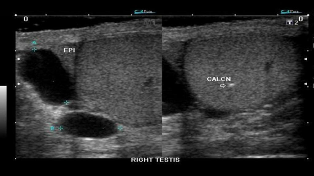 Fig. 21: Grayscale ultrasound image of the right testicle shows disruption of the tunica albuginea with extrusion of the testicle through the