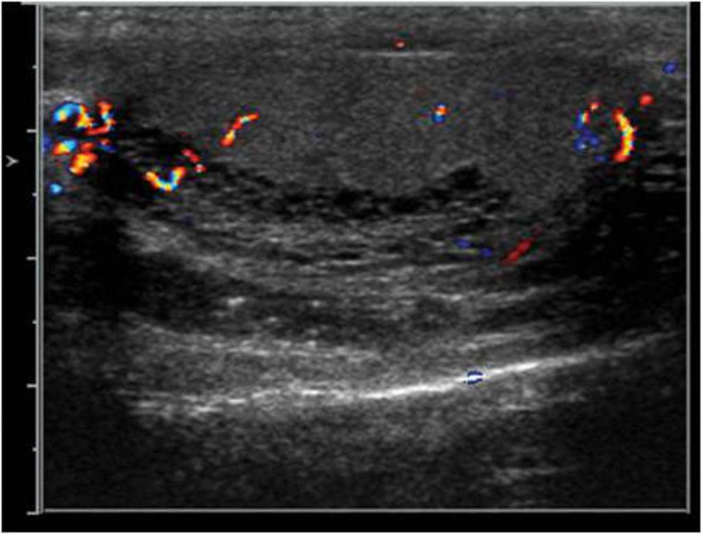 Fig. 23: Color Doppler ultrasound image of the left testicle showing multiple anechoic structures located near the mediastinum testis.
