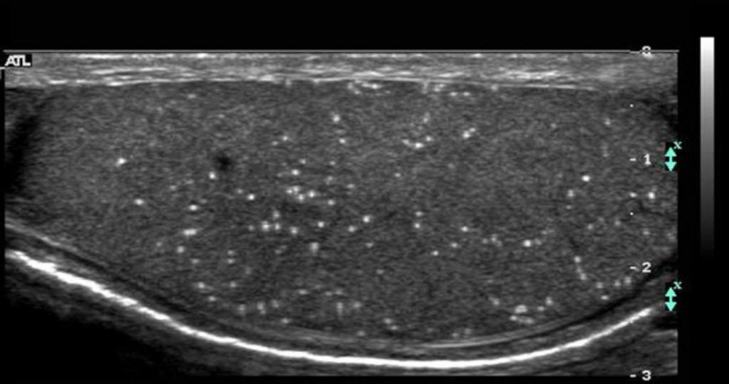 Fig. 24: Grayscale ultrasound image of the left testicle shows multiple punctate areas of increased