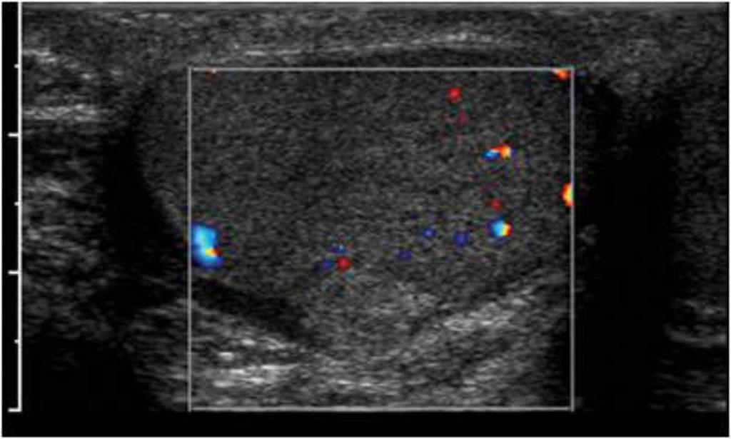 Fig. 26: Color Doppler ultrasound image show relatively well-defined, mobile paratesticular lesion, which have similar to slightly increased