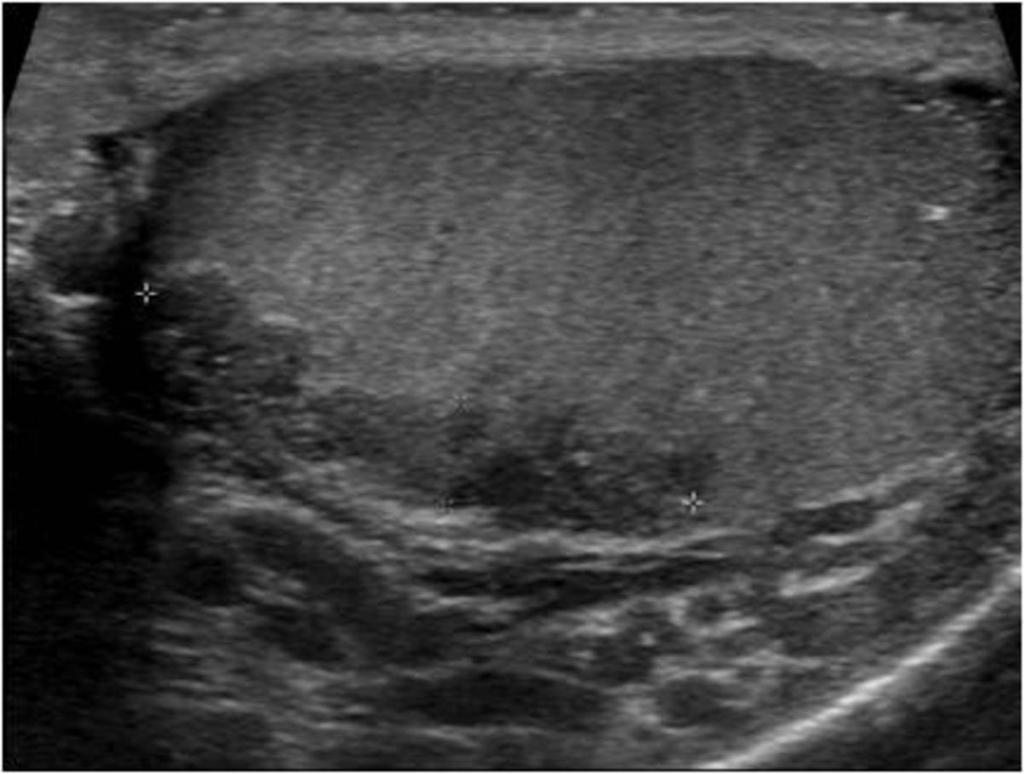 Fig. 27: Grayscale ultrasound image of the left testis shows hypoechoic masses within the peripheral portion of the testis with more normal