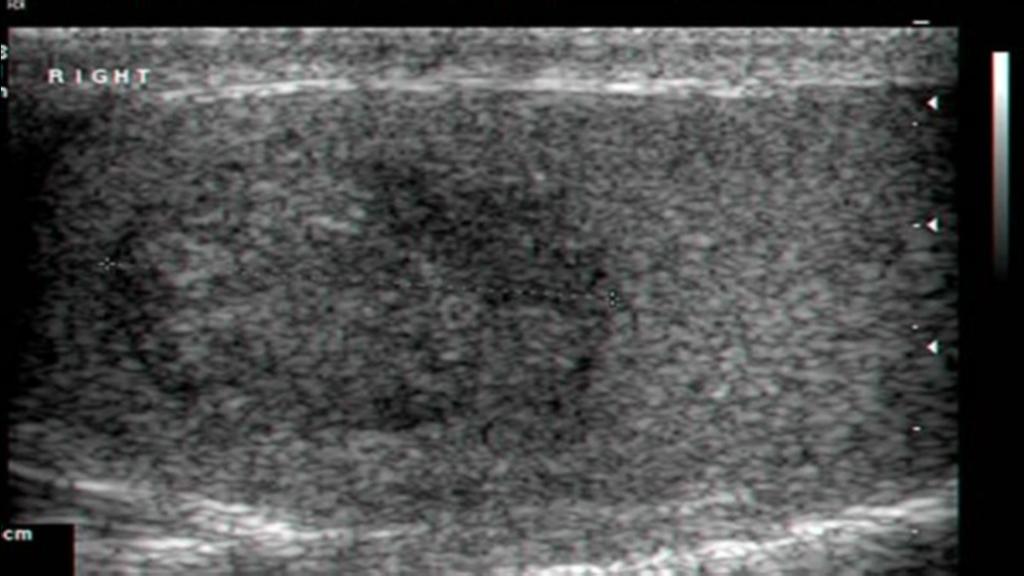 Fig. 28: Grayscale ultrasound image of the right testicle shows hypoechoic masse with some