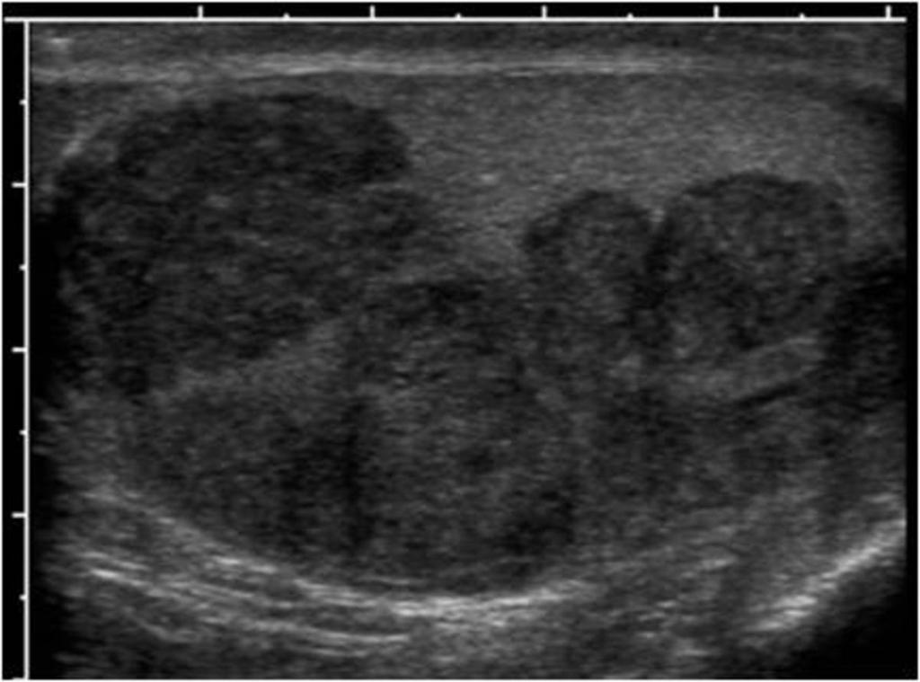 Fig. 29: Grayscale ultrasound image of the right testicle show multiple hypoechoic masses throughout