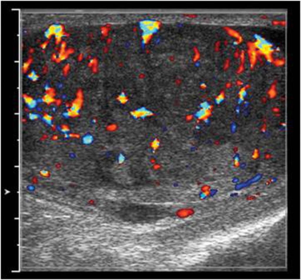 Fig. 31: Grayscale ultrasound image of the left testicle show multiple ill-defined hypoechoic masses within the testicle. Biopsy confirmed non-hodgkin's lymphoma. Fig.