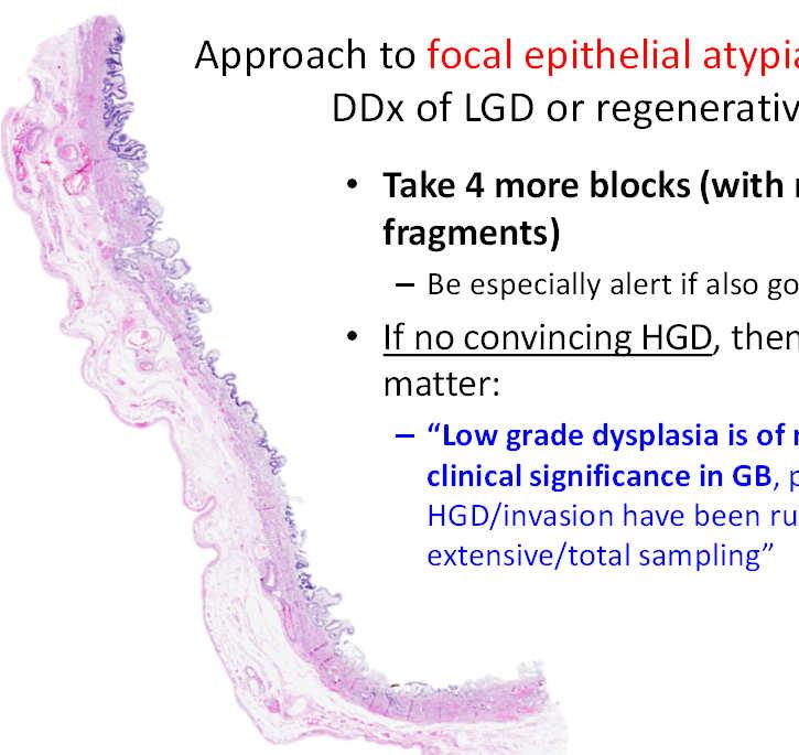 Approach to focal epithelial atypia (FEA) w DDx of LGD or regenerative Take 4 more blocks (with multiple