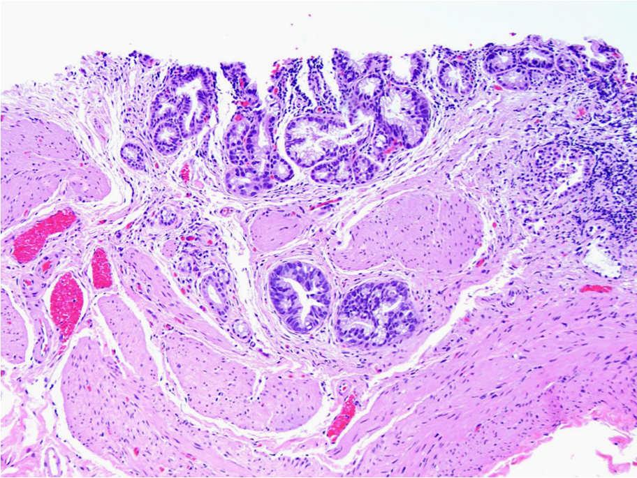 Invasive adenocarcinoma Case Our Diagnosis High-grade dysplasia/carcinoma in-situ of gallbladder,